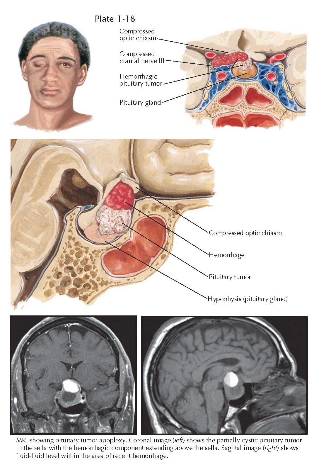 Апоплексия гипофиза мрт